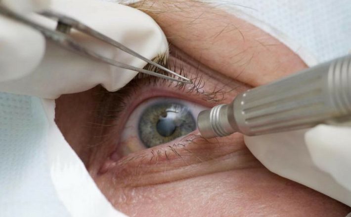 Pandemia faz cair detecção precoce de glaucoma