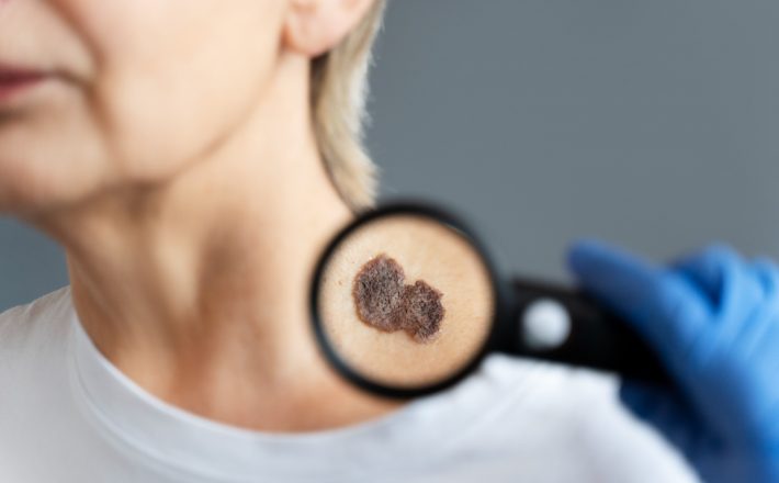 Melanoma cutâneo: entenda os fatores de risco para o tipo mais perigoso de câncer de pele