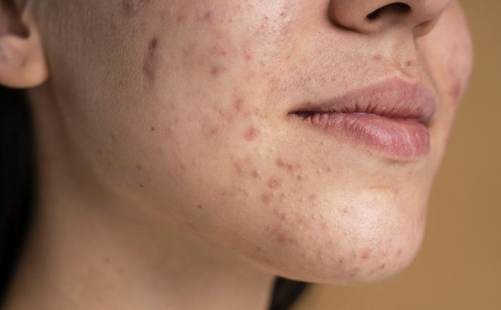 Dermatologia e autoestima: o impacto emocional de doenças de pele