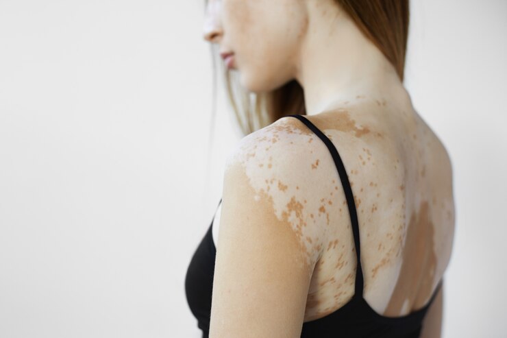 Vitiligo sem tabu: hidratar, proteger e respeitar a pele faz toda a diferença