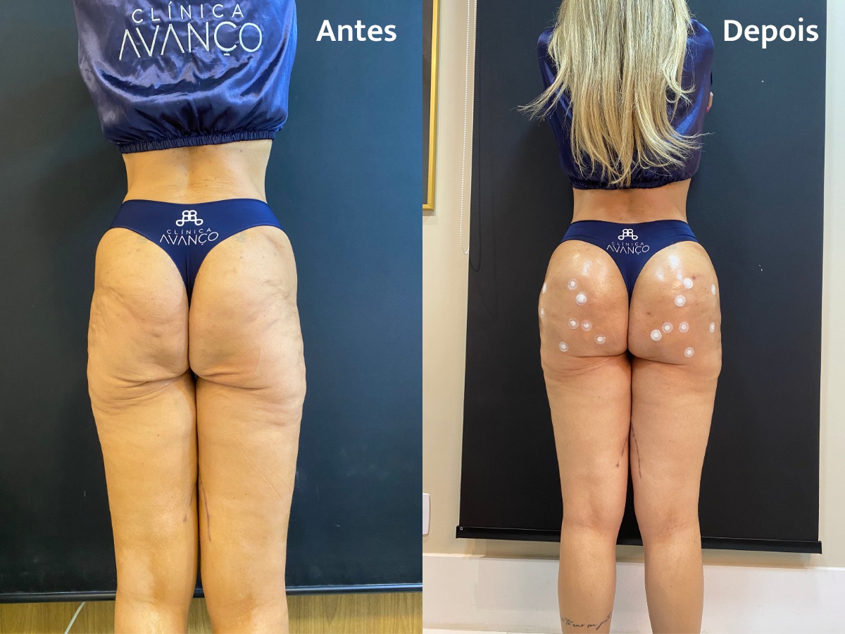 Harmonização glútea corrige flacidez após bariátrica: entenda como funciona