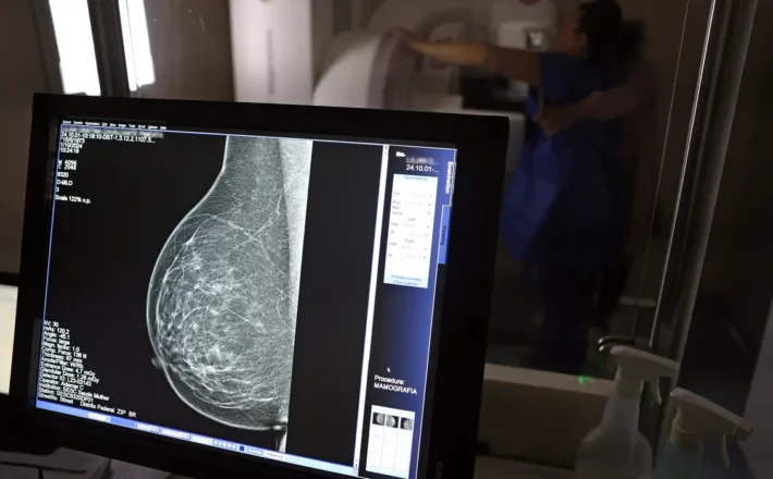 Ministério da Saúde passa a recomendar mamografia a partir dos 40 anos