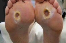 Diabetes e doenças vasculares elevam riscos de amputação de pernas e pés
