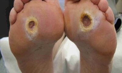 Diabetes e doenças vasculares elevam riscos de amputação de pernas e pés