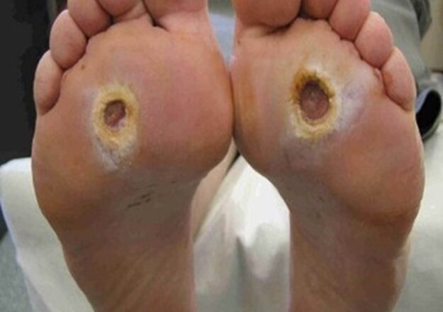 Diabetes e doenças vasculares elevam riscos de amputação de pernas e pés