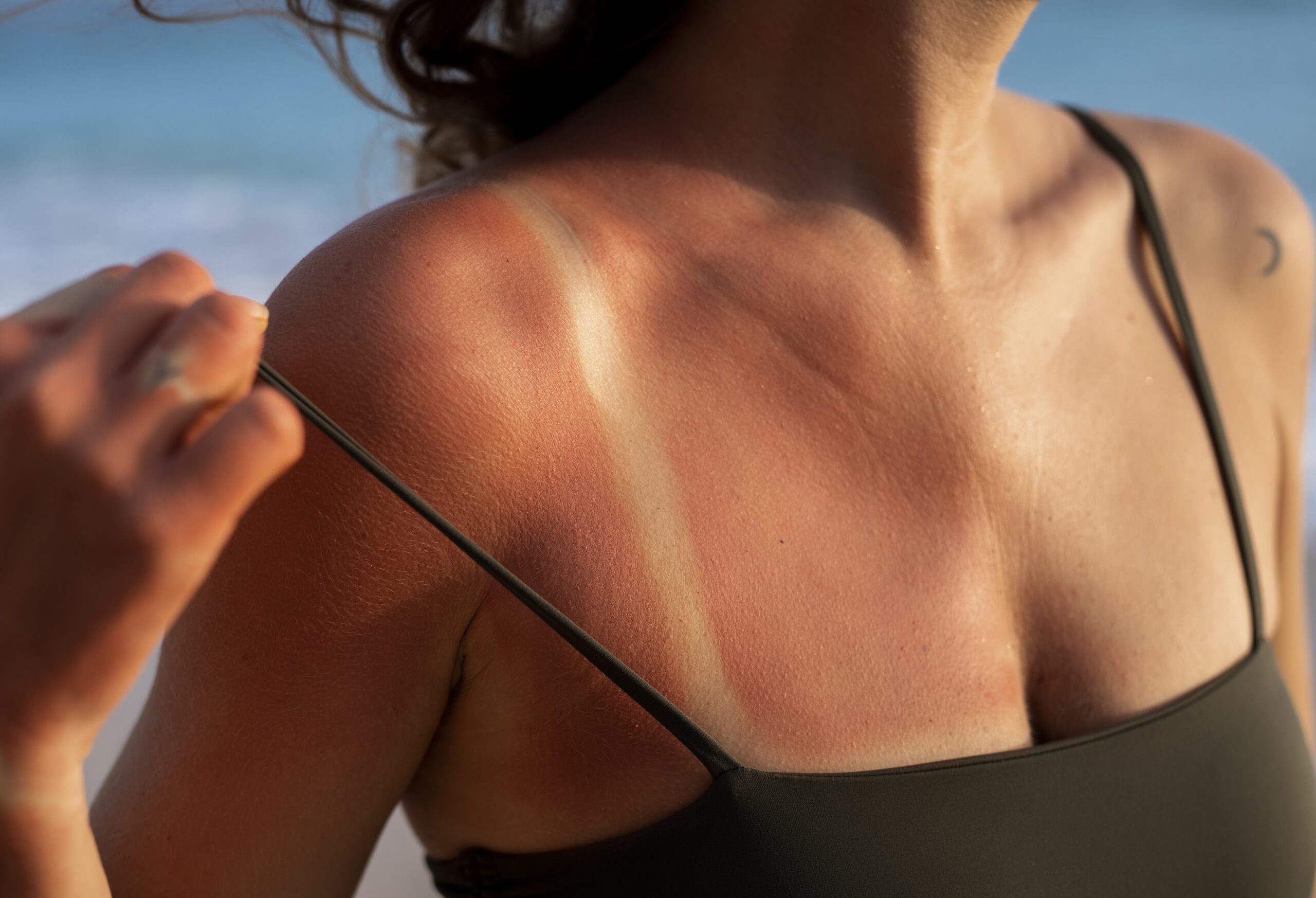 Movimento anti protetor solar: dermatologista destaca os perigos para a saúde da pele