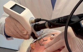 Mitos e verdades sobre o uso de laser CO₂ no tratamento da pele