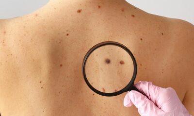 Tipo mais comum de câncer no país ainda é cercado de mitos, alerta especialista