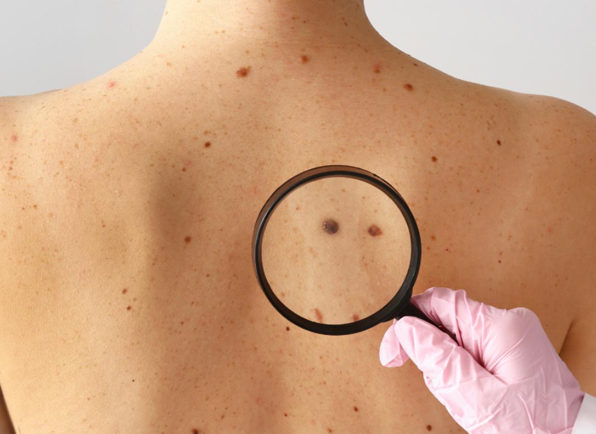 Tipo mais comum de câncer no país ainda é cercado de mitos, alerta especialista