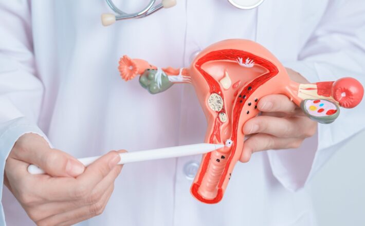 Dor intensa na menstruação pode ser sinal de endometriose, alerta especialista do MPHU