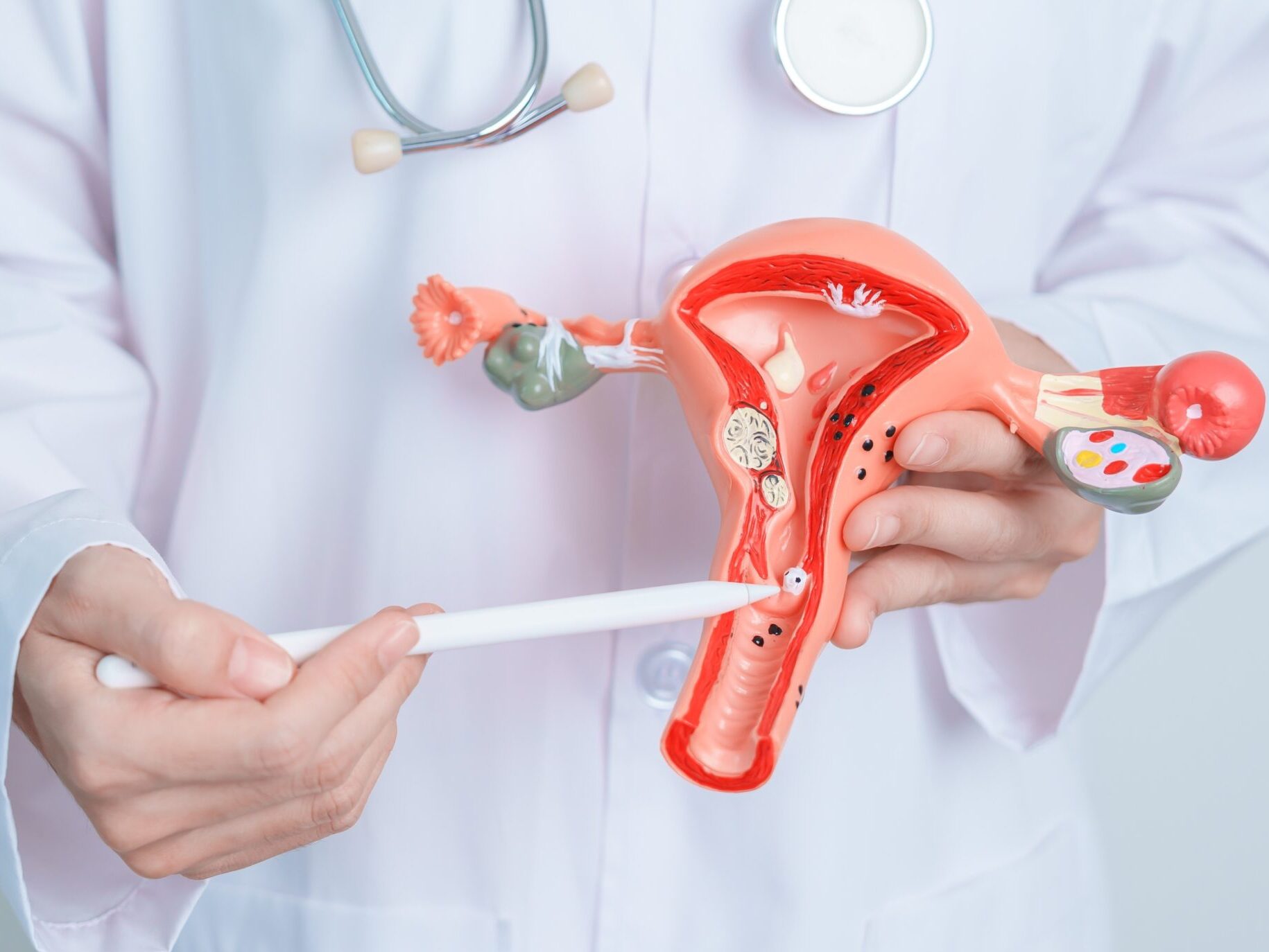 Dor intensa na menstruação pode ser sinal de endometriose, alerta especialista do MPHU